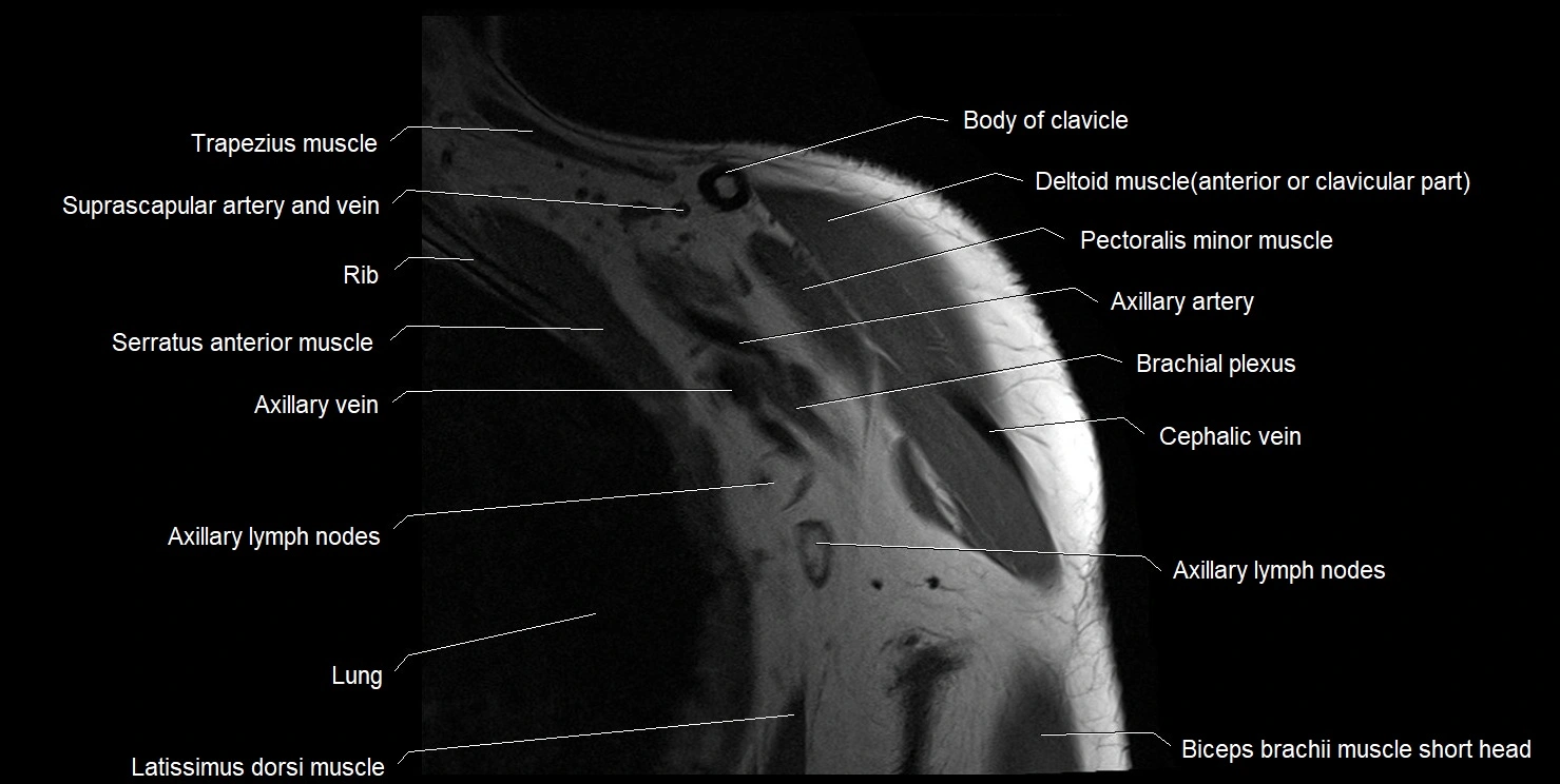 mri shoulder coronal cross sectional anatomy image 1.webp